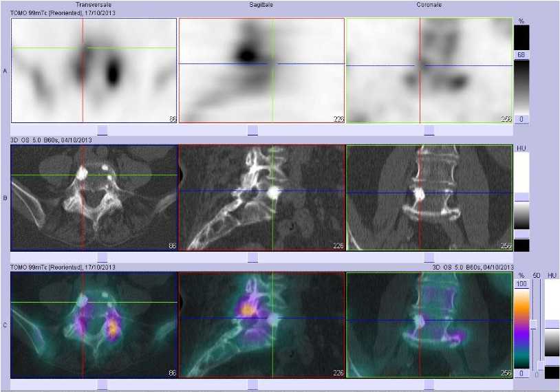 M&eacute;tastase ost&eacute;ocondensante du corps vert&eacute;bral de L5