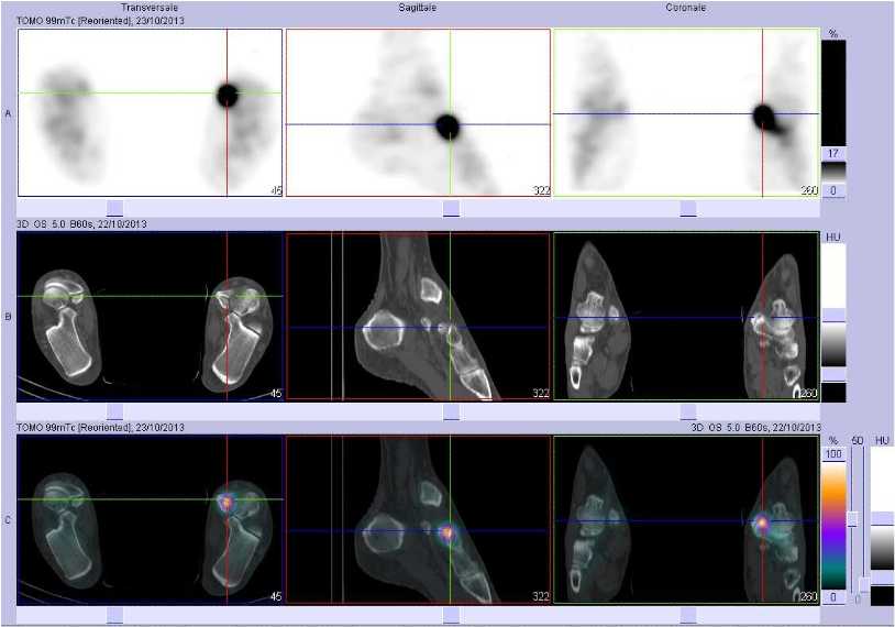 Tendinopathie du muscle tibial post&eacute;rieur gauche
