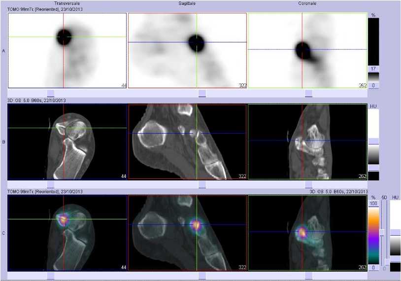 Tendinopathie du muscle tibial post&eacute;rieur gauche