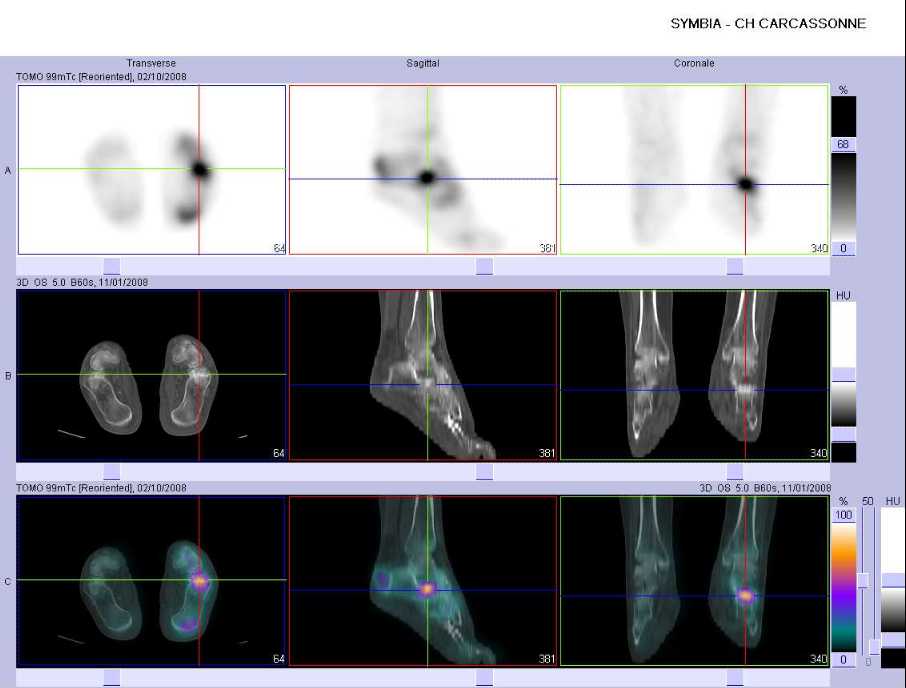 Fracture par insuffisance osseuse de l'apophyse ant&eacute;rieure du calcaneus gauche