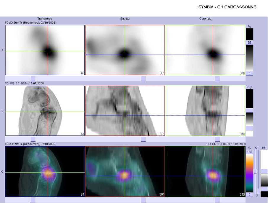 Fracture par insuffisance osseuse de l'apophyse ant&eacute;rieure du calcaneus gauche