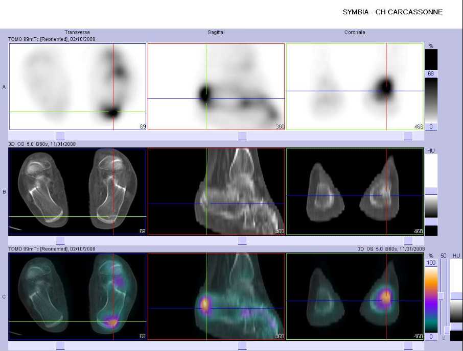 Fracture par insuffisance osseuse de la grosse tub&eacute;rosit&eacute; du calcaneus gauche