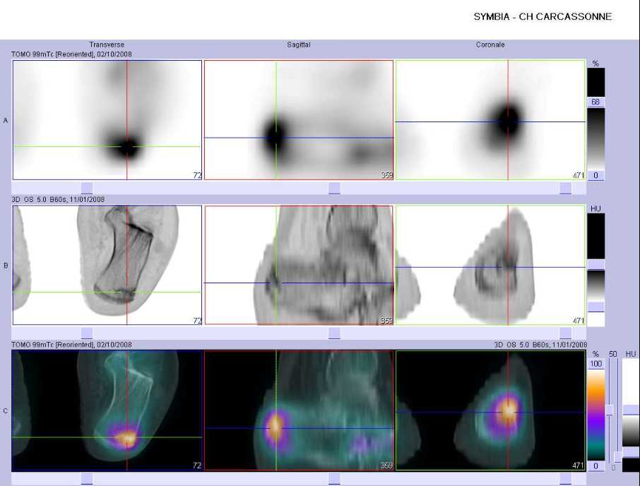 Fracture par insuffisance osseuse de la grosse tub&eacute;rosit&eacute; du calcaneus gauche