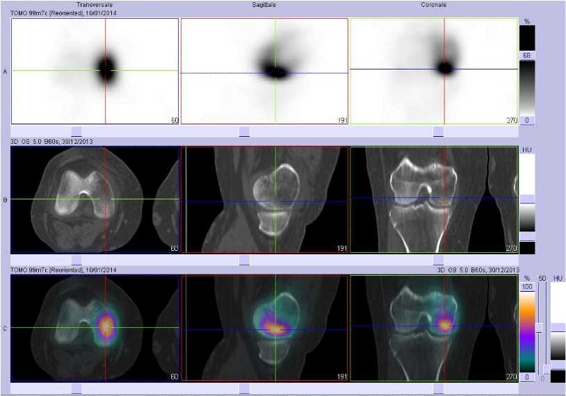 Fracture sous chondrale du condyle f&eacute;moral m&eacute;dial droit
