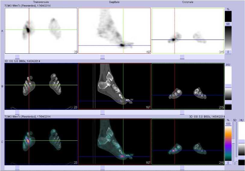 Arthrite de la 3&egrave;me articualtion m&eacute;tatarso phalangienne droite