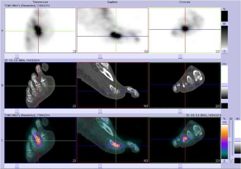 Arthrite de la 3&egrave;me articualtion m&eacute;tatarso phalangienne droite