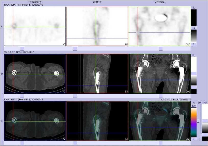 Fractures de la diaphyse f&eacute;morale droite