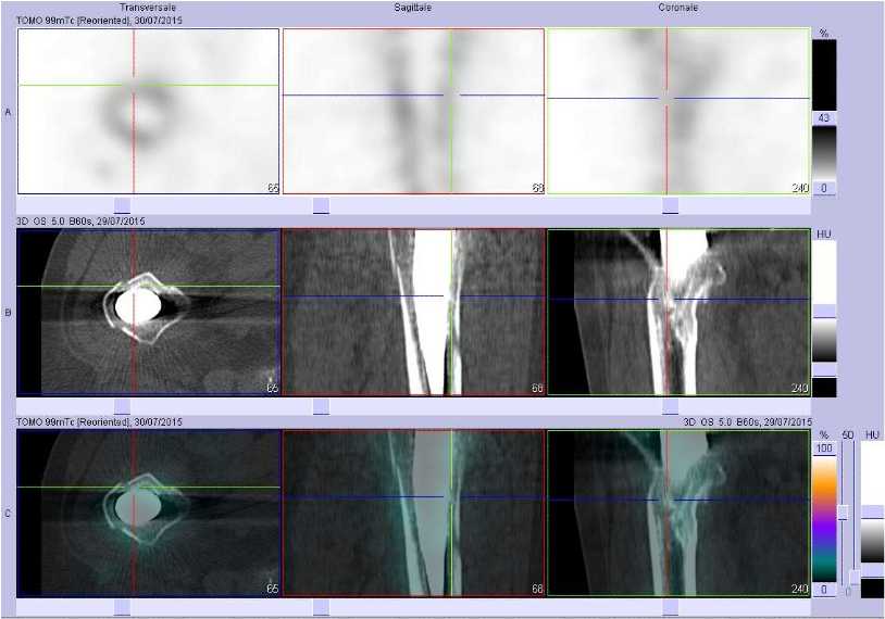 Fractures de la diaphyse f&eacute;morale droite