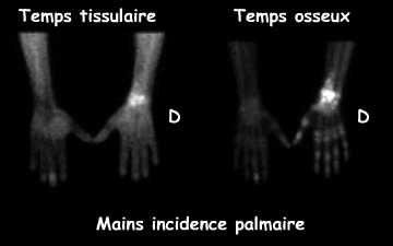 Mains - Temps tissulaire et temps osseux