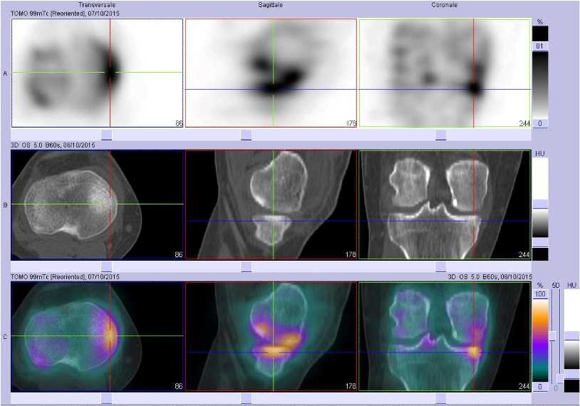 R&eacute;action ost&eacute;ochondrale sur le plateau tibial interne droite