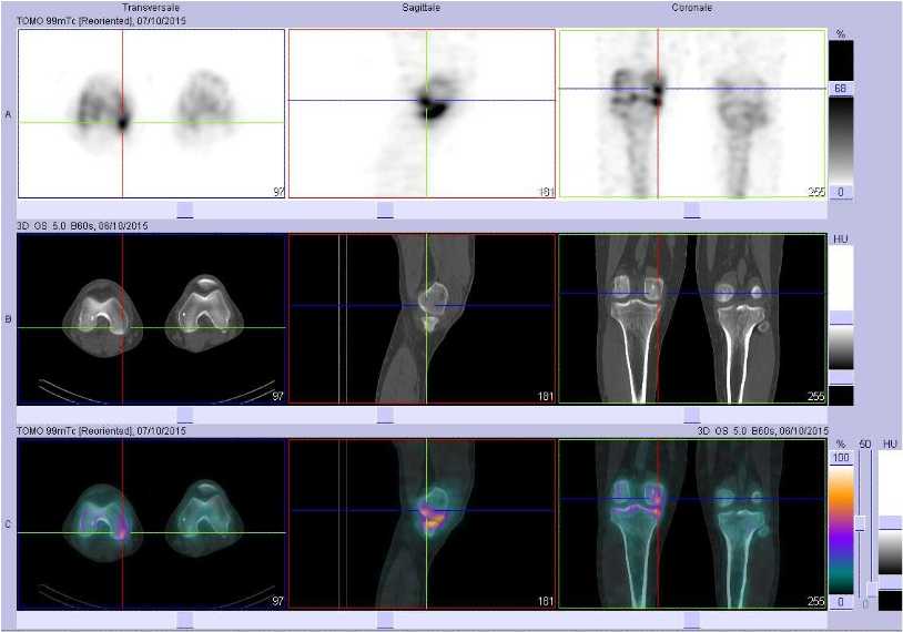 L&eacute;sions ost&eacute;ochondrales du condyle f&eacute;moral interne droit