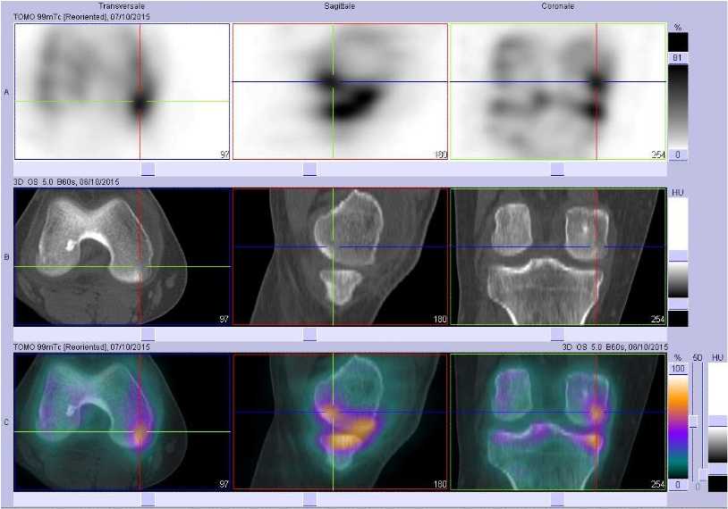L&eacute;sions ost&eacute;ochondrales du condyle f&eacute;moral interne droit