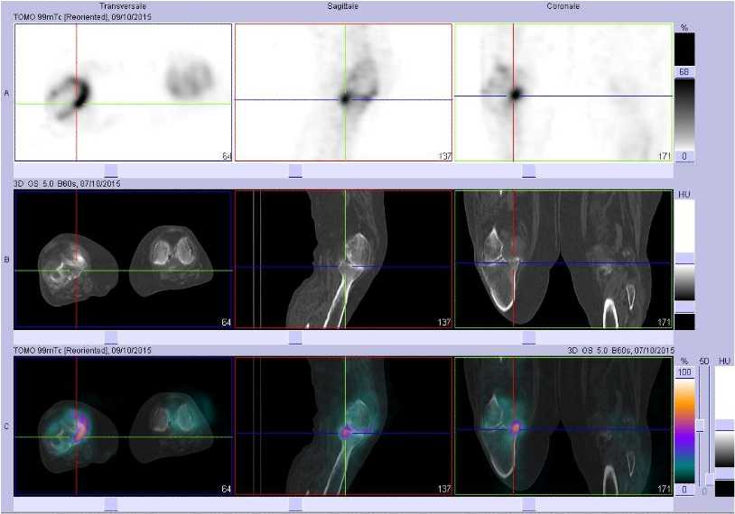Fracture du rebord post&eacute;rieur du plateau tibial m&eacute;dial droit