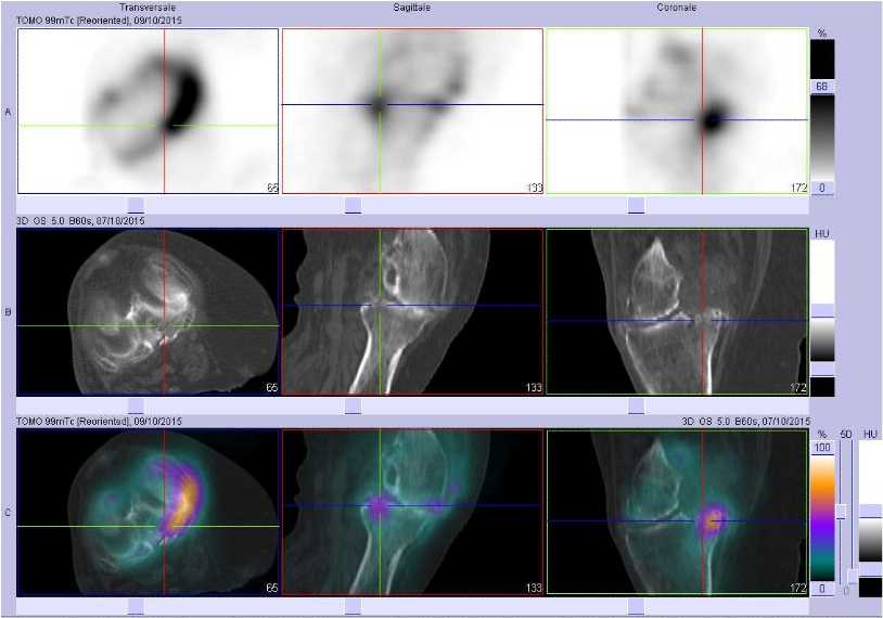 Fracture du rebord post&eacute;rieur du plateau tibial m&eacute;dial droit