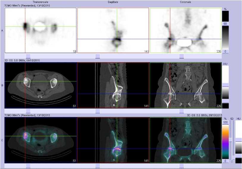 Coxarthrose droite &eacute;volu&eacute;e