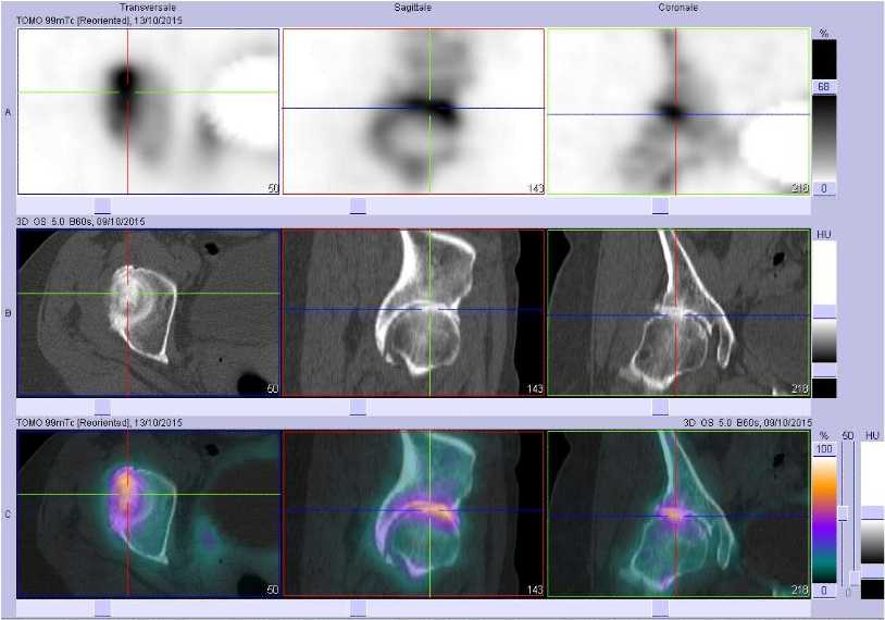 Coxarthrose droite &eacute;volu&eacute;e