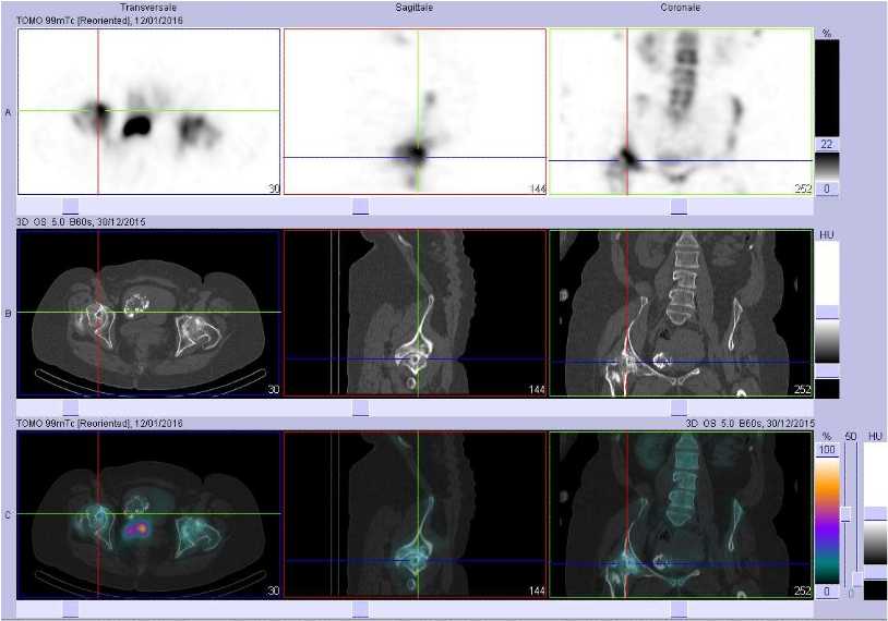 Coxarthrose droite