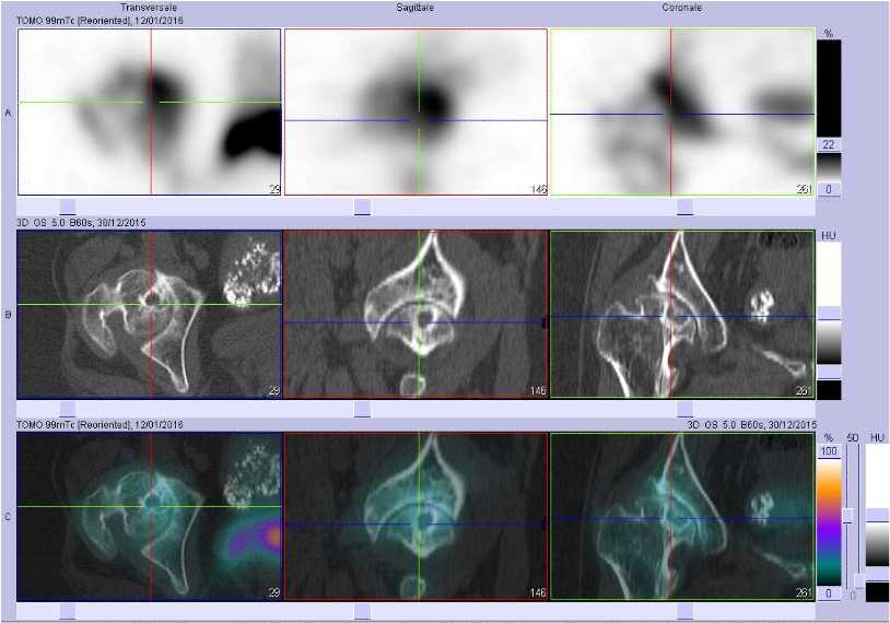 Coxarthrose droite