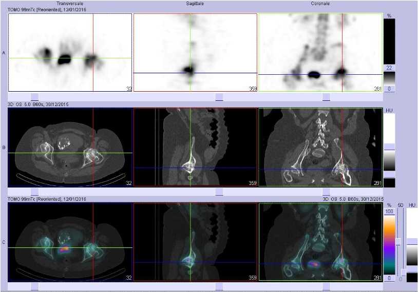 Coxarthrose gauche
