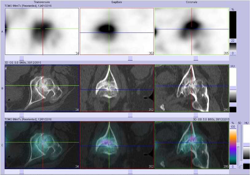Coxarthrose gauche