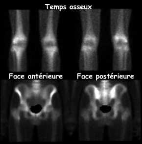 Temps osseux