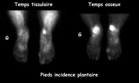 Temps tissulaire et temps osseux - Incidence plantaire