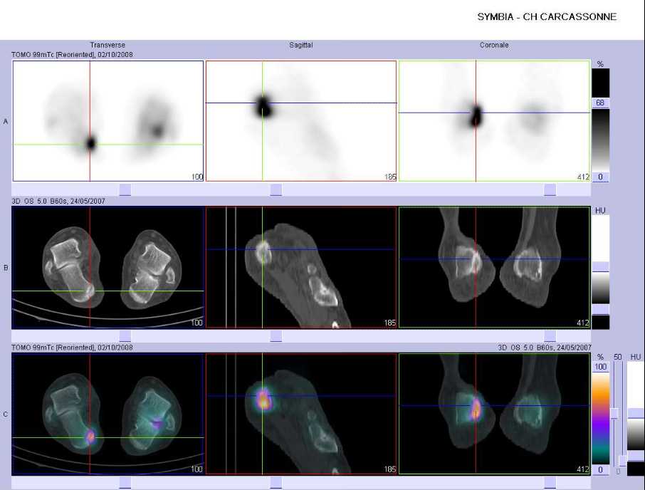 Fracture de la grosse tub&eacute;rosit&eacute; du calcaneus droit