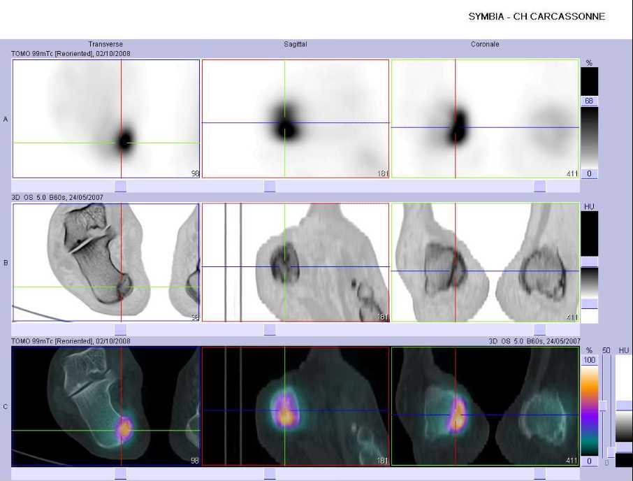 Fracture de la grosse tub&eacute;rosit&eacute; du calcaneus droit