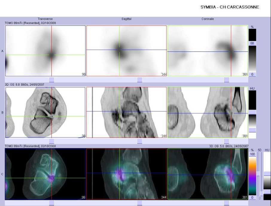 S&eacute;quelles de fracture du talus gauche