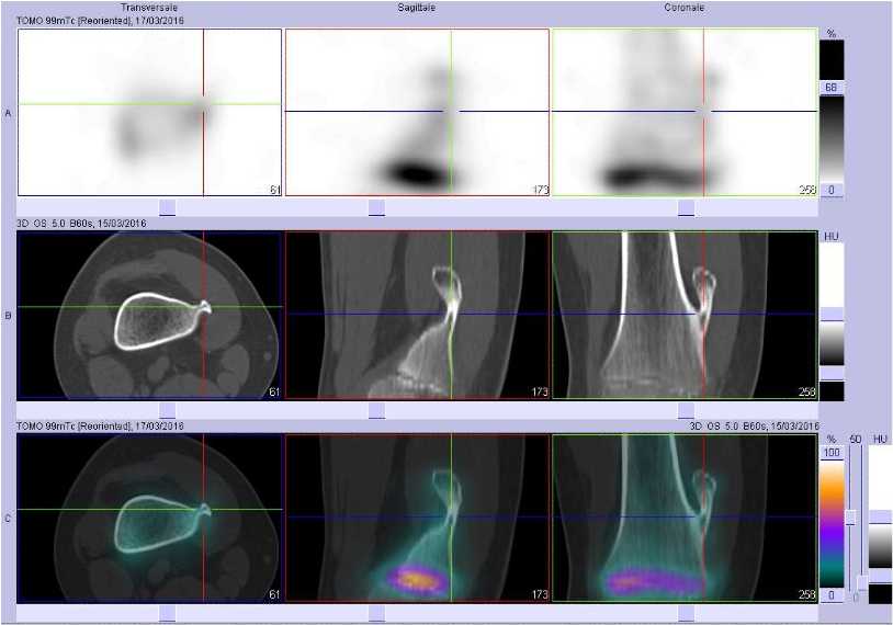 Exostose f&eacute;morale inf&eacute;rieure droite