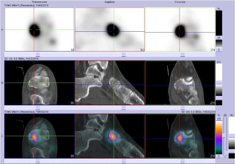 Fracture de la tub&eacute;rosit&eacute; interne du naviculaire gauche