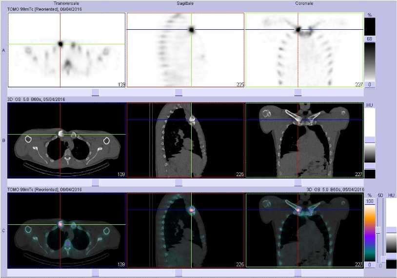 Ost&eacute;ite aseptique de l'extr&ecirc;mit&eacute; interne de la clavicule droite
