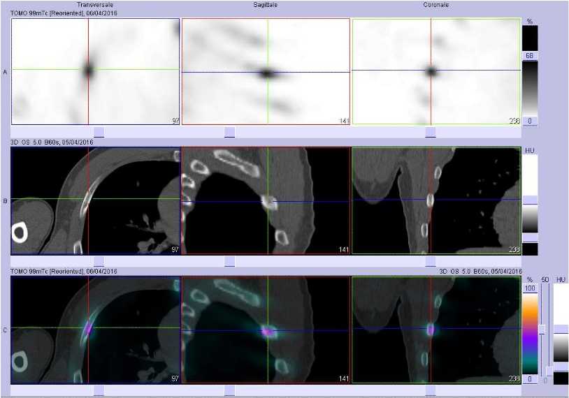 Ost&eacute;ite aseptique costale droite