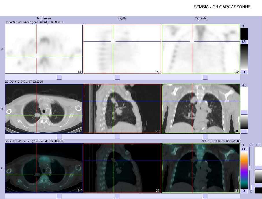 L&eacute;sion pulmonaire droite suspecte