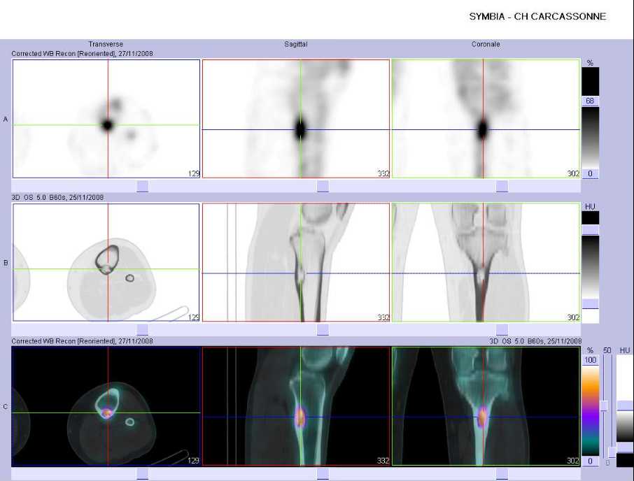 Fibrome non ossifiant tibial sup&eacute;rieur gauche