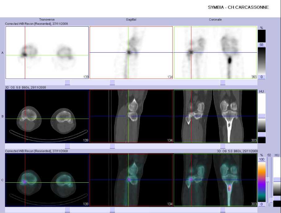 Pathologie traumatique de l'articulation tibio-fibulaire sup&eacute;rieure droite