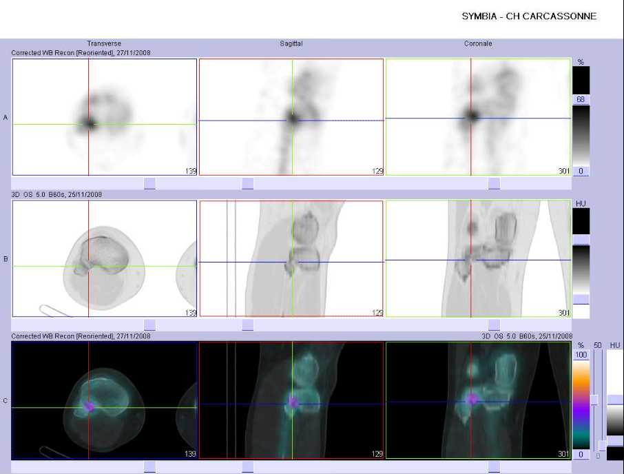 Pathologie traumatique de l'articulation tibio-fibulaire sup&eacute;rieure droite