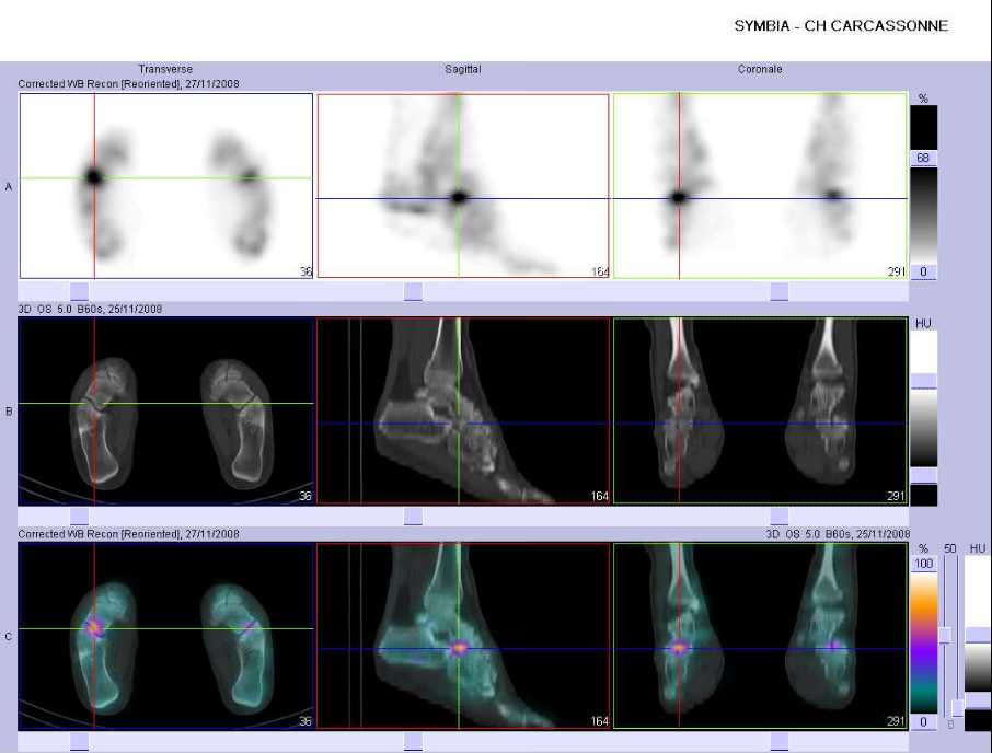 Pathologie microtraumatique m&eacute;diotarsienne droite