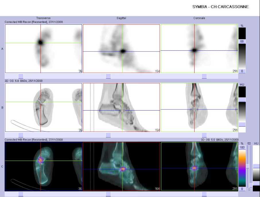 Pathologie microtraumatique m&eacute;diotarsienne droite