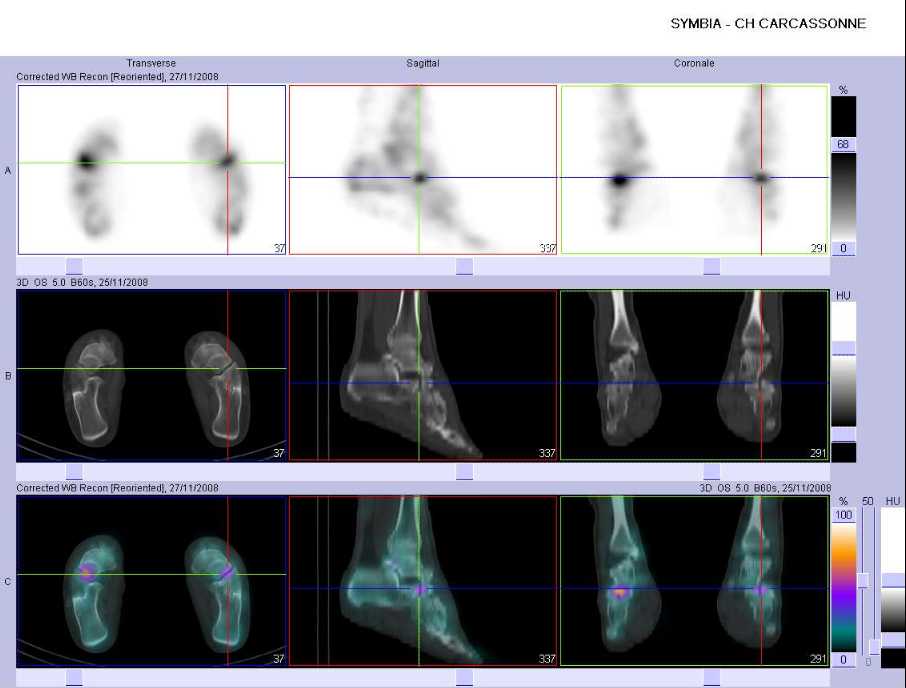 Pathologie microtraumatique m&eacute;diotarsienne gauche