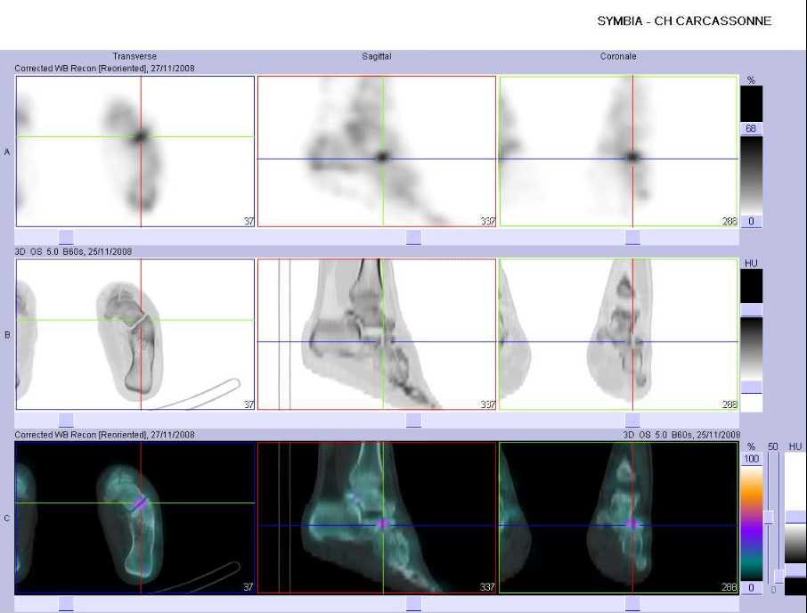 Pathologie microtraumatique m&eacute;diotarsienne gauche
