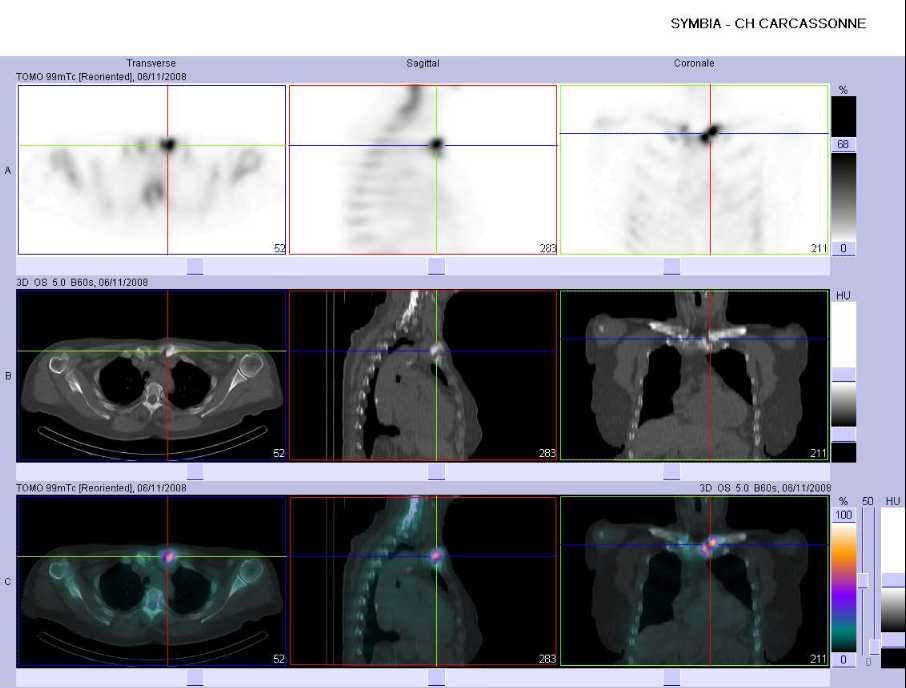 L&eacute;sions ost&eacute;olytiques du versant scapulaire de l'articulation sterno-claviculaire gauche