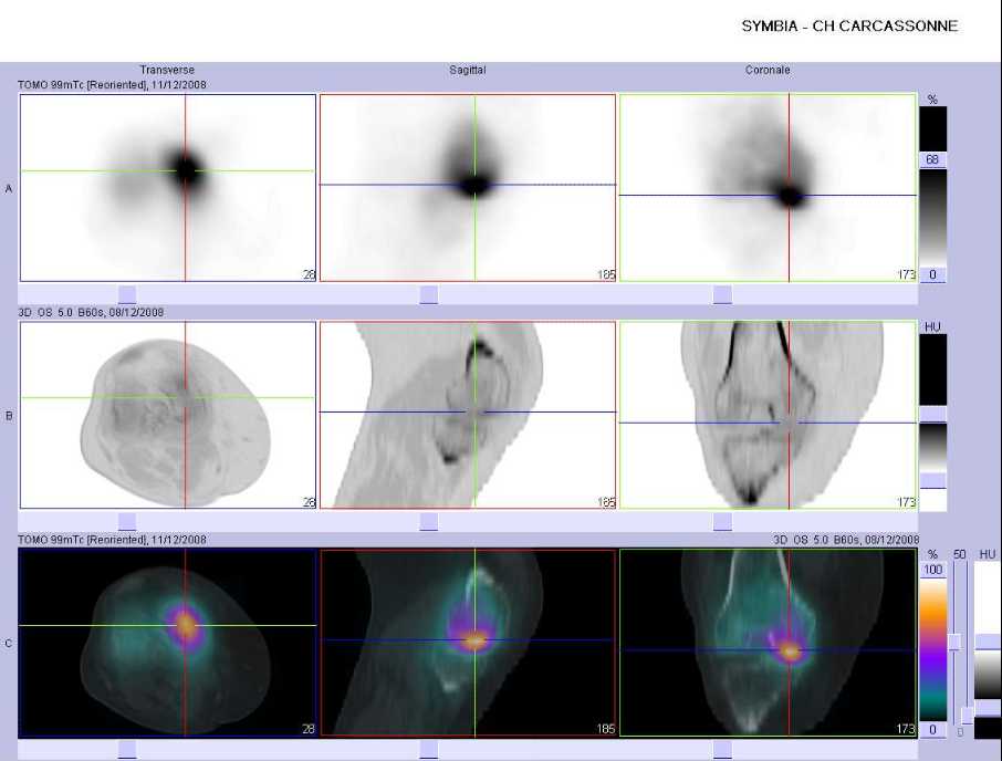 Fracture par insuffisance osseuse du condyle f&eacute;moral m&eacute;dial droit