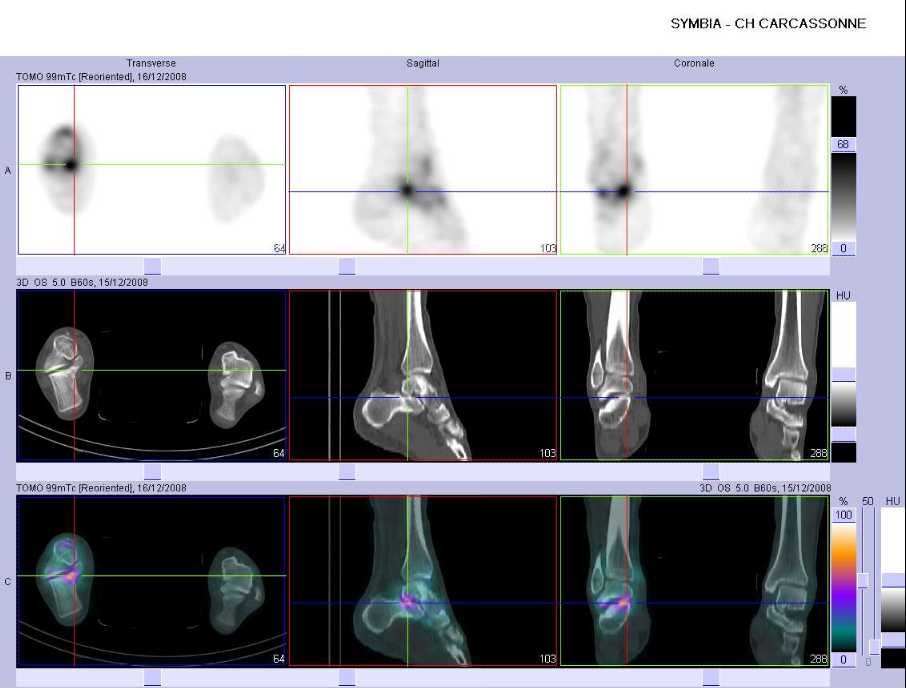 L&eacute;sion microtraumatique de l'articulation sous-talienne droite