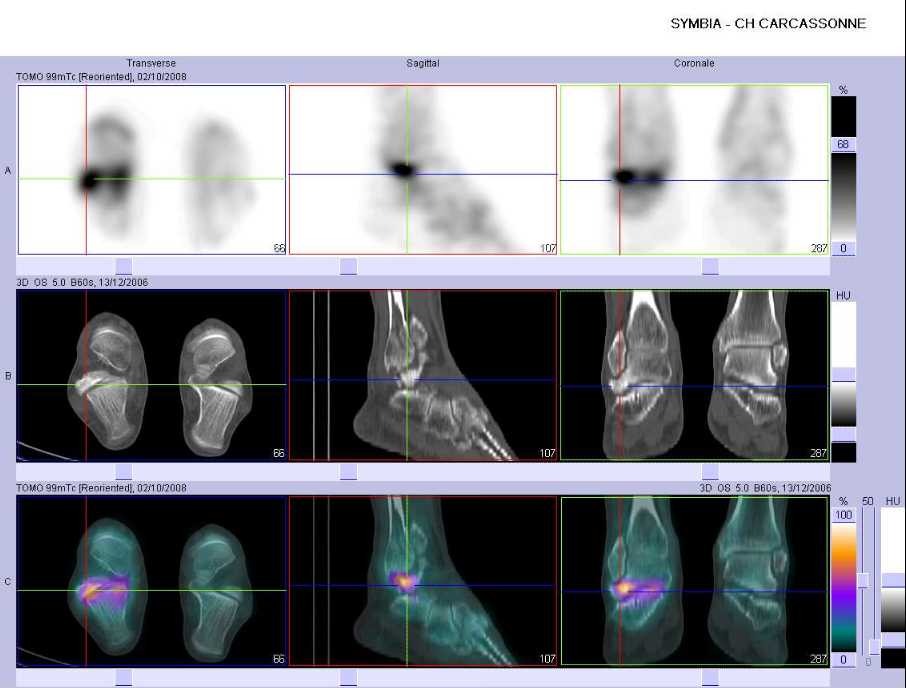 Fracture du processus lat&eacute;ral du talus droit