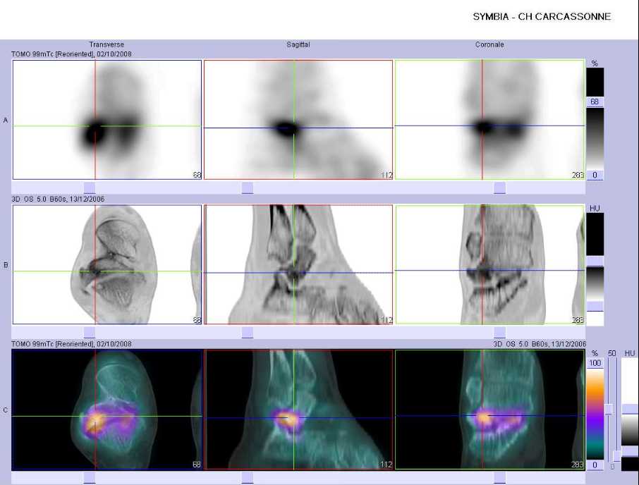 Fracture du processus lat&eacute;ral du talus droit