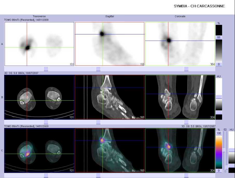 Fracture de la marge post&eacute;rieure du tibia droit