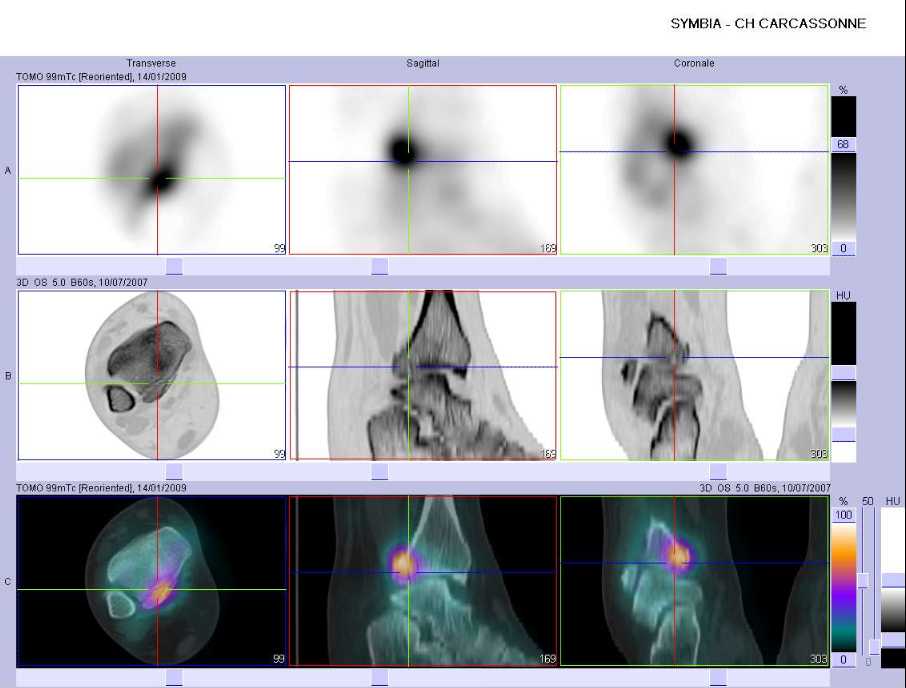Fracture de la marge post&eacute;rieure du tibia droit