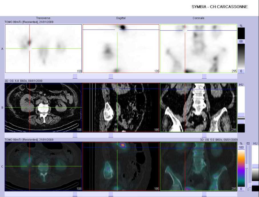 L&eacute;sion r&eacute;nale droite &eacute;vocatrice d'une n&eacute;oplasie