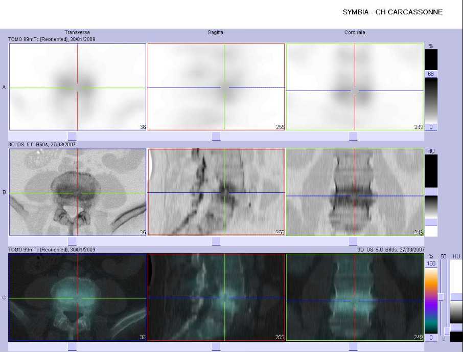 Discopathie L4-L5 et spondylolisth&eacute;sis